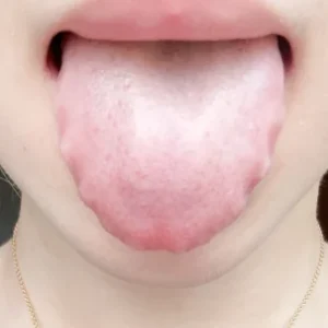 Toothmark Tongue