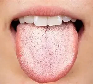 White Greasy Tongue
